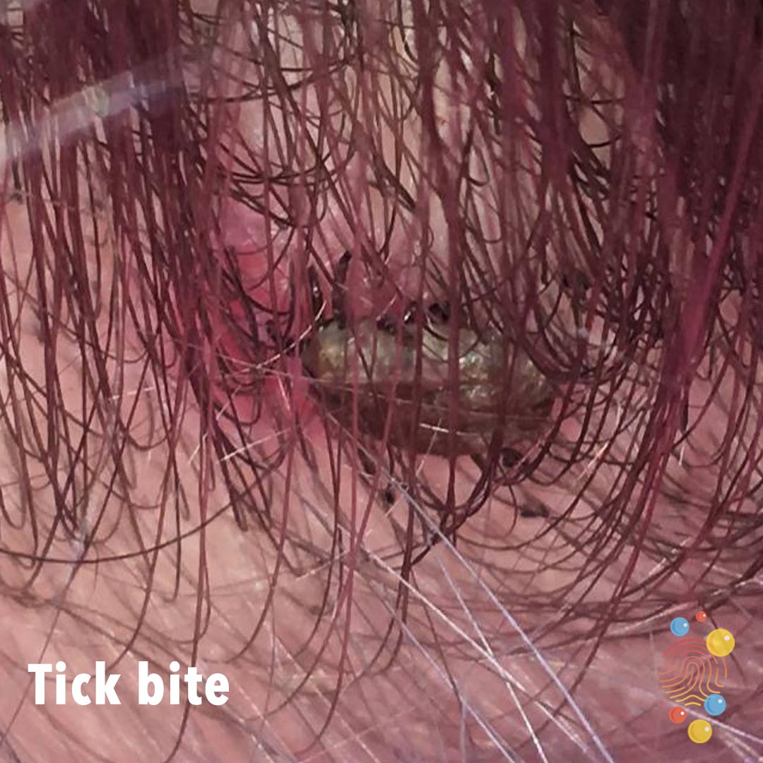 D155b-tick-bite.jpg